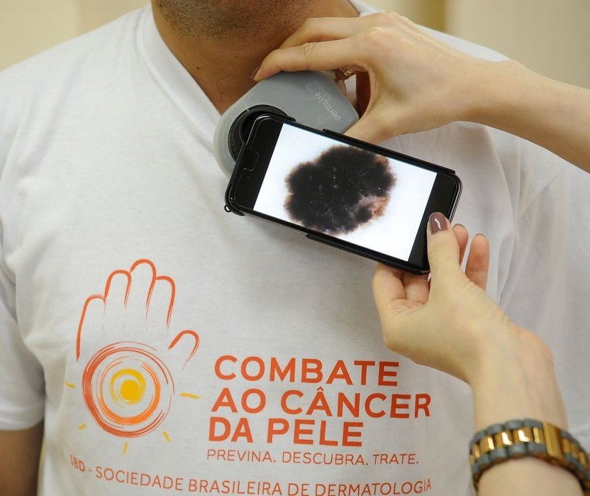 Junho é um mês de conscientização sobre o melanoma