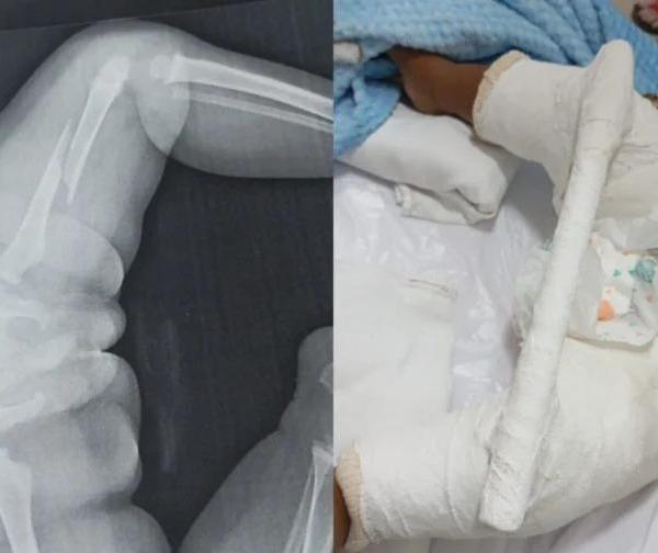 Bebê de 1 ano e 5 meses é internado em Maringá com fratura no fêmur